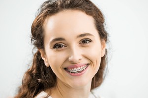 Elastiques intermaxillaires de classe III LDM