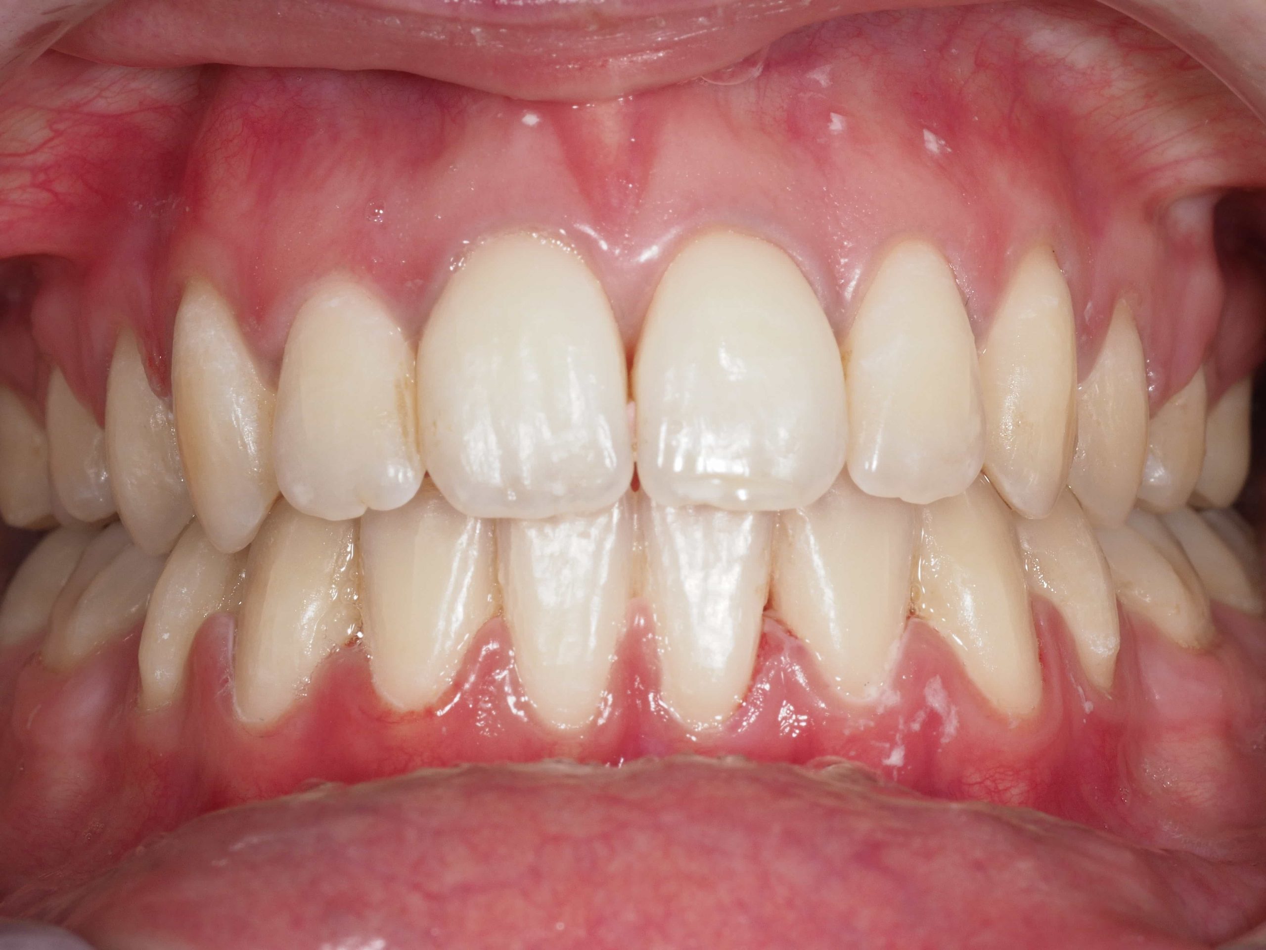 Orthodontie adulte Orthodontiste Saint Gély du Fesc