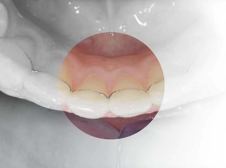 fil de contention cabinet orthodontie LDM Saint Gely du Fesc